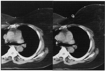 photo of CT Breast Image with and without Bravelle Breast Ring