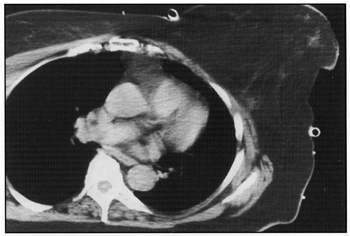 photo of CT Image of Breast with Bravelle