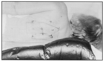 photo of back of patient on side in Alpha Cradle immobilization device